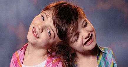 カナダの7歳の結合双生児姉妹、大脳を共用し、生命の奇跡を作り